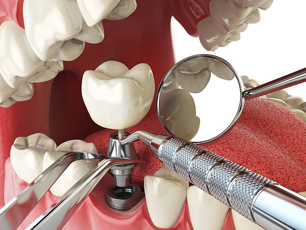Best Emergency Dental Care for Broken or Chipped Teeth in , NH